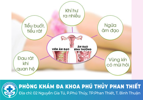 Khí hư màu trắng đục như sữa chua do viêm âm đạo