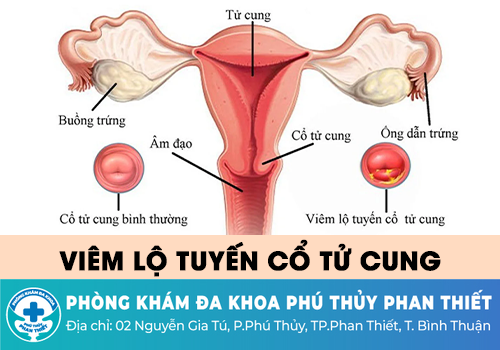 Viêm lộ tuyến cổ tử cung là gì?