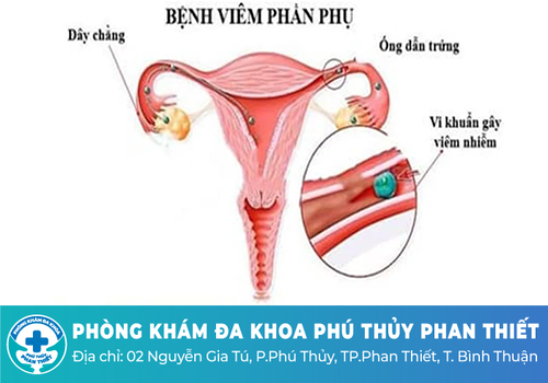 Khí hư màu trắng đục và ngứa do viêm phần phụ