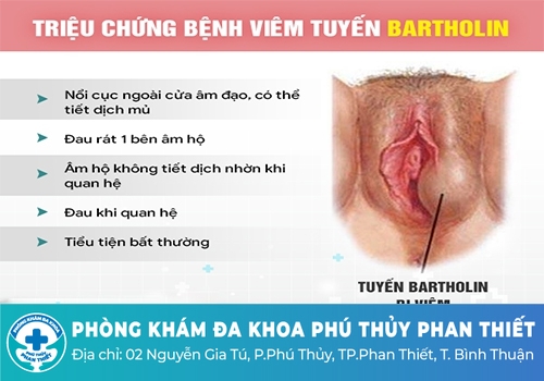 Nổi mụn cứng vùng kín không đau ở nữ giới là bệnh gì?