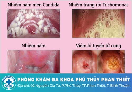 Nguyên nhân dẫn đến tình trạng huyết trắng bột