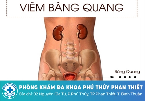 Viêm bàng quang là gì?
