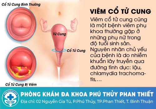 Viêm cổ tử cung là gì?