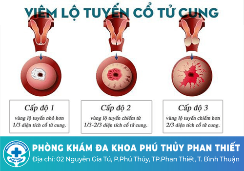 Hôi âm đạo do viêm lộ tuyến cổ tử cung